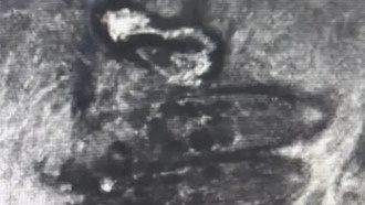 У 13-летнего мальчика в глазах обнаружили более 80 клещей