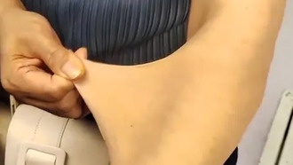 У женщины редкое заболевание: кожа растягивается как резина