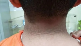 13-летний подросток с ожирением диагностирован с чёрным акантозом из-за инсулинорезистентности