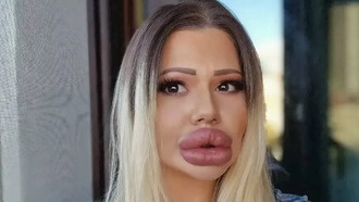 Женщина потратила 2 млн рублей на увеличение губ, но теперь не может лечить зубы