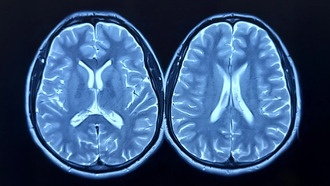 Пандемия COVID-19 могла ускорить старение мозга даже у здоровых людей