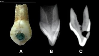 Учёные обнаружили зубы детей майя с нефритовыми вставками