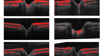 ИИ предсказывает риск ухудшения зрения у астронавтов до полёта в космос