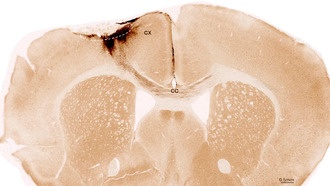 Учёные обратили повреждения от инсульта вспять с помощью стволовых клеток