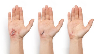 Умный пластырь с ИИ ускоряет заживление ран на 25%