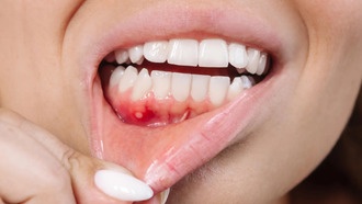 Растительное соединение морин может стать новым средством от болезней десен