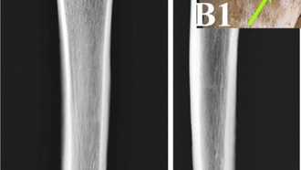 Ученые нашли останки парфянского воина со стрелой в ноге