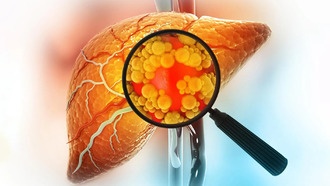 Исследование выявило главные причины смерти пациентов с жировой болезнью печени