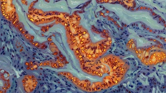 Учёные нашли генетический переключатель, делающий рак поджелудочной железы устойчивым к химиотерапии