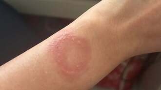 Apple Watch оставил пользователю ожоговый шрам, дело в поддержке тянется месяцами