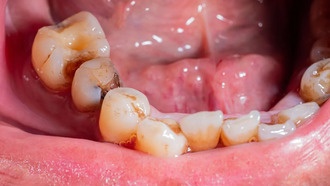 Лечение зубной инфекции может улучшить уровень сахара в крови и здоровье сердца